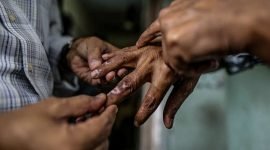 Ilustrasi penyakit kusta (foto: news.okezone.com)