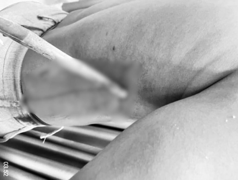 Anak panah menancap di bagian rusuk kanan tubuh korban. (Foto: Istimewa)