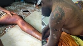 Tampak sejumlah bekas luka pada tubuh Ortizan F. Tarage, korban yang diduga disiksa oleh oknum anggota polisi di Sorong. (Foto: Istimewa/Dok. LBH Papua Pos Sorong)