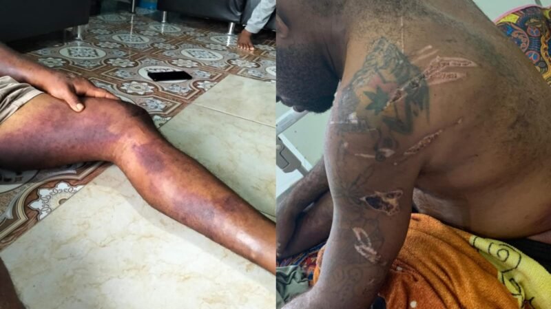 Tampak sejumlah bekas luka pada tubuh Ortizan F. Tarage, korban yang diduga disiksa oleh oknum anggota polisi di Sorong. (Foto: Istimewa/Dok. LBH Papua Pos Sorong)